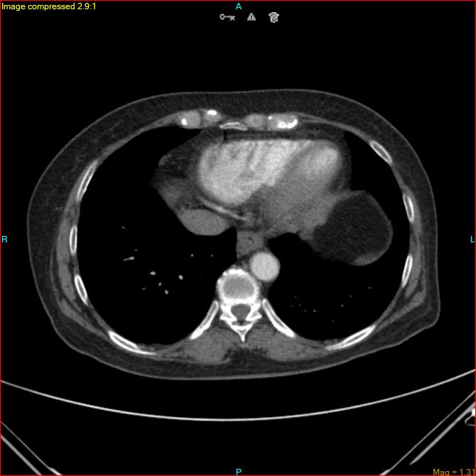 Azygos vein aneurysm (Radiopaedia 77824-90130 B 42).jpg