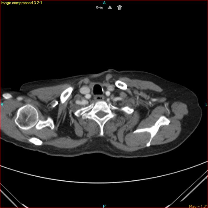 Azygos vein aneurysm (Radiopaedia 77824-90130 B 7).jpg
