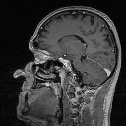Balo concentric sclerosis (Radiopaedia 50458-55940 Sagittal T1 C+ 91).jpg