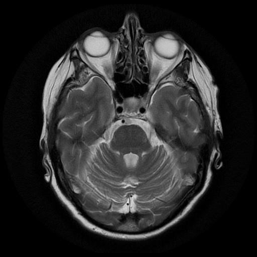 File:Balo concentric sclerosis (Radiopaedia 53875-59982 Axial T2 8).jpg