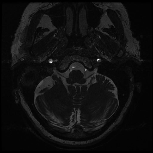 File:Balo concentric sclerosis (Radiopaedia 53875-59982 Axial T2 FIESTA 11).jpg