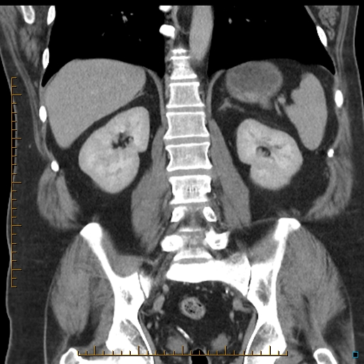 File:Bariatric balloon causing gastric outlet obstruction (Radiopaedia 54449-60672 B 41).jpg