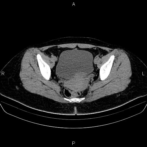 Bartholin gland cyst (Radiopaedia 62635-70930 Axial non-contrast 51).jpg