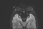 File:Basal cell carcinoma - nasal region (Radiopaedia 70292-80365 Axial DWI 17).jpg