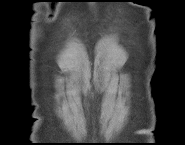 Basal ganglia metastasis (Radiopaedia 78928-91832 C 49).png