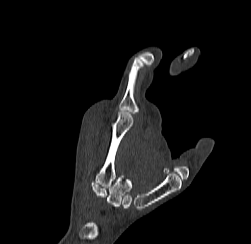 Base of 2nd metacarpal fracture (Radiopaedia 73741-84544 Coronal bone window 58).jpg