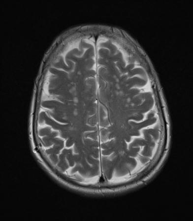 File:Base of skull chondrosarcoma (Radiopaedia 30410-31070 Axial T2 16).jpg