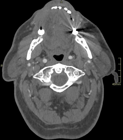 Basilar artery aneurysm (Radiopaedia 56261-62932 A 26).jpg