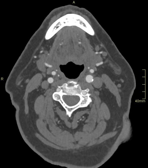 Basilar artery aneurysm (Radiopaedia 56261-62932 A 3).jpg