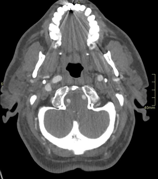 Basilar artery aneurysm (Radiopaedia 56261-62932 A 35).jpg