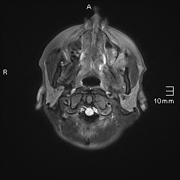File:Basilar artery perforator aneurysm (Radiopaedia 82455-99523 Axial FLAIR 1).jpg