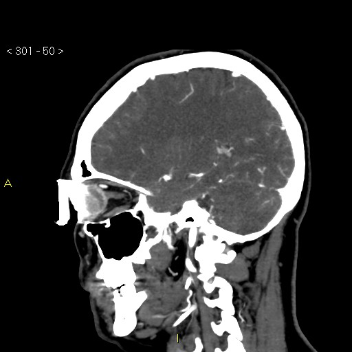Basilar artery thrombosis (Radiopaedia 16260-15944 C 44).jpg