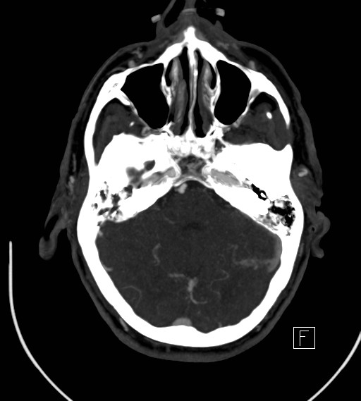 Basilar artery thrombosis (Radiopaedia 26986-27163 A 29).jpg