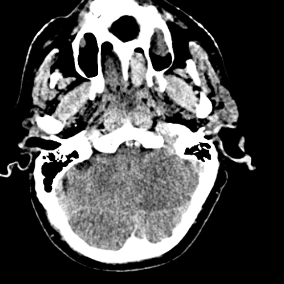 File:Basilar artery thrombosis (Radiopaedia 53351-59333 Axial non-contrast 33).jpg