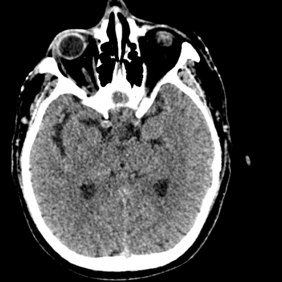 Basilar artery thrombosis (Radiopaedia 53351-59333 Axial non-contrast 59).jpg