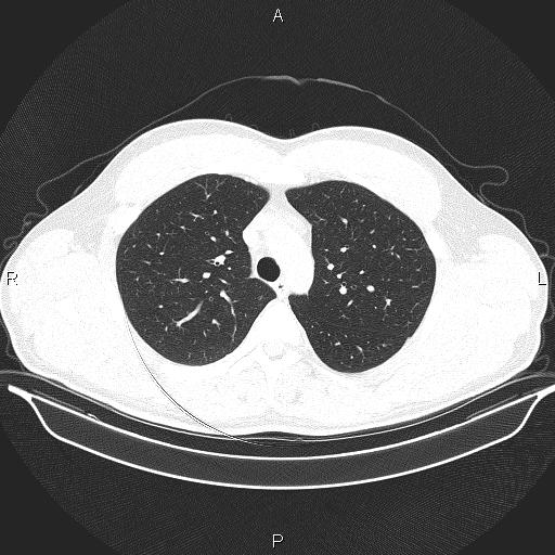 Beam hardening and ring artifacts (Radiopaedia 85323-100915 Axial lung window 25).jpg