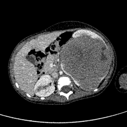 Beckwith-Wiedeman syndrome with bilateral Wilms tumors (Radiopaedia 60850-68629 A 58).jpg
