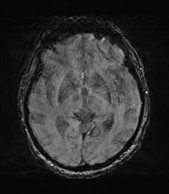 File:Behavioral variant frontotemporal dementia and late onset schizophrenia (Radiopaedia 52197-58083 Axial SWI 34).png