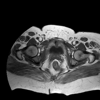 File:Benign seromucinous cystadenoma of the ovary (Radiopaedia 71065-81300 Axial T1 3).jpg