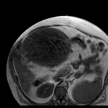 File:Benign seromucinous cystadenoma of the ovary (Radiopaedia 71065-81300 Axial T1 33).jpg