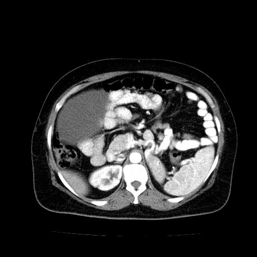 Benign spindle cell tumor - abdominopelvic (Radiopaedia 61300-69212 A 19).jpg