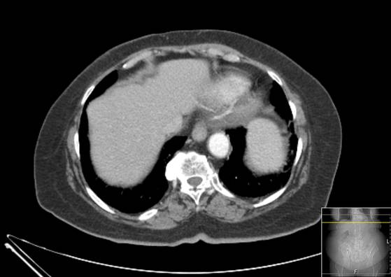 Bicameral celiacomesenteric aneurysm (Radiopaedia 55766-62327 A 5).jpg