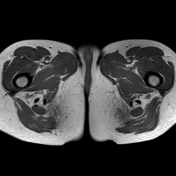 File:Bicornuate uterus (Radiopaedia 61974-70046 Axial T1 47).jpg
