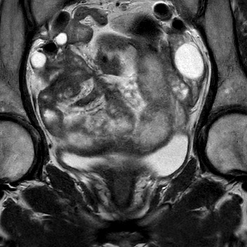 File:Bicornuate uterus (Radiopaedia 61974-70046 Coronal T2 8).jpg
