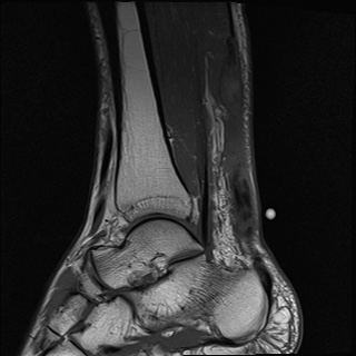 File:Bilateral Achilles tendon complete tear (Radiopaedia 81344-95051 Sagittal T1 10).jpg