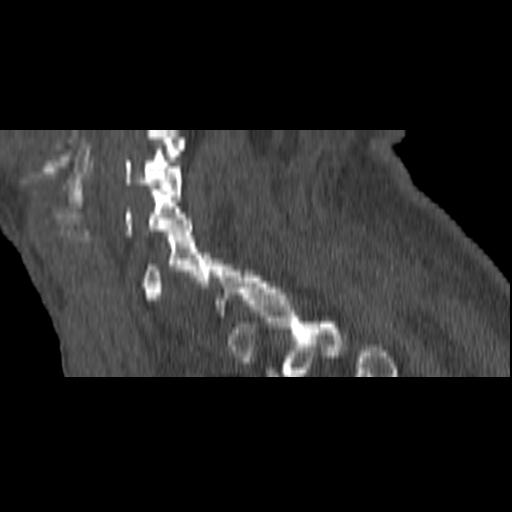 File:Bilateral C6-7 locked facet dislocation (Radiopaedia 28506-28748 Sagittal bone window 4).jpeg