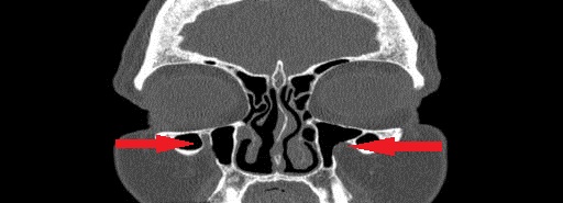File:Bilateral Ectopic Infraorbital Nerves (Radiopaedia 49006-58325 Coronal 4).jpg