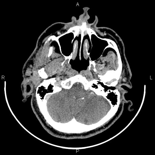 Bilateral Warthin tumors (Radiopaedia 84034-99263 Axial With contrast 10).jpg