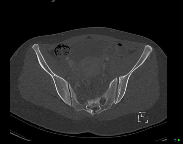 File:Bilateral acetabular fractures (Radiopaedia 79272-92308 Axial bone window 26).jpg