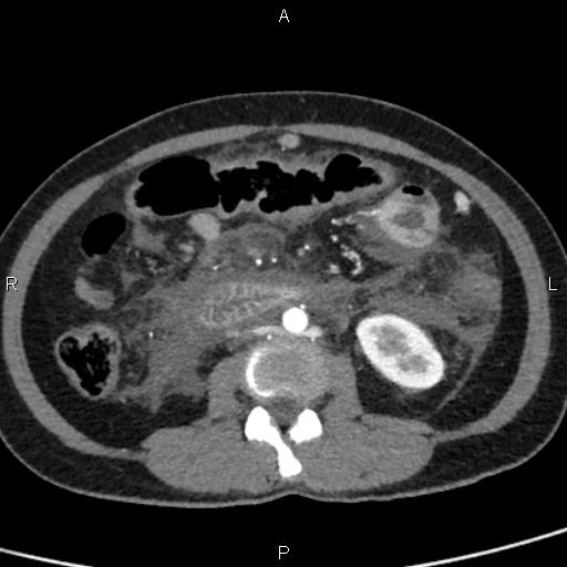 Bilateral adrenal gland hyperenhancement in pancreatitis (Radiopaedia 86642-102753 B 74).jpg