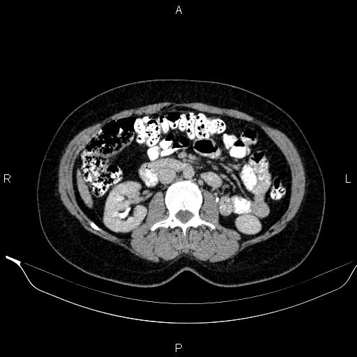 Bilateral adrenal myelolipoma (Radiopaedia 63058-71535 Axial C+ delayed 61).jpg