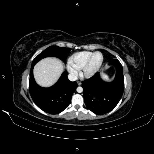 File:Bilateral adrenal myelolipoma (Radiopaedia 63058-71535 B 10).jpg