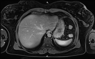 Bilateral adrenal myelolipoma (Radiopaedia 63058-71537 H 17).jpg