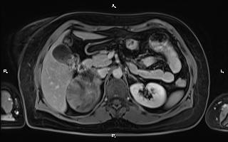 File:Bilateral adrenal myelolipoma (Radiopaedia 63058-71537 H 40).jpg