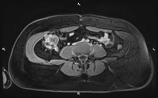 File:Bilateral adrenal myelolipoma (Radiopaedia 63058-71537 H 73).jpg