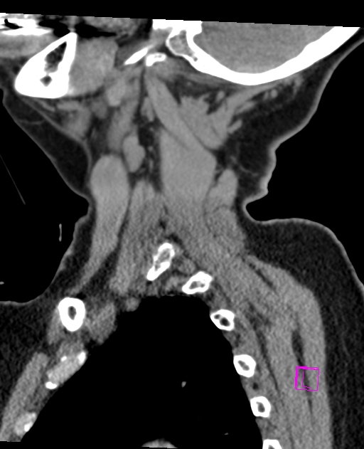 Bilateral atlanto-occipital assimilation (Radiopaedia 28350-28603 D 15).jpg