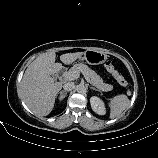 Bilateral benign adrenal adenomas (Radiopaedia 86912-103124 Axial C+ delayed 34).jpg