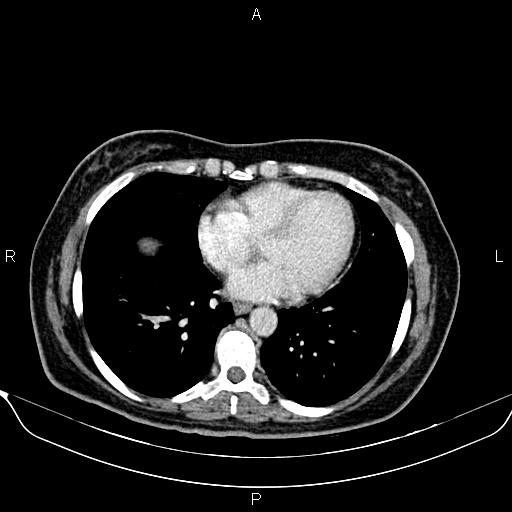 Bilateral benign adrenal adenomas (Radiopaedia 86912-103124 B 7).jpg