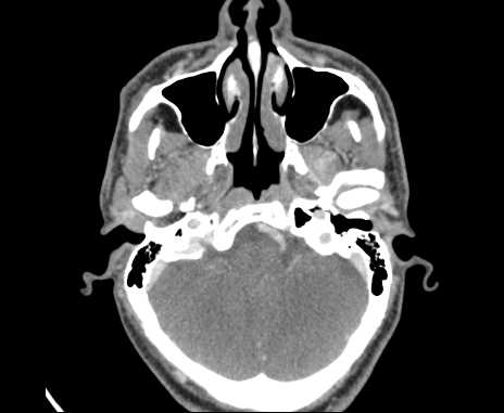 Bilateral carotid body tumors (Radiopaedia 61841-69870 Axial Post contrast 4).jpg