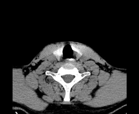 Bilateral carotid body tumors (Radiopaedia 61841-69870 Axial non-contrast 86).jpg