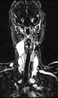 Bilateral carotid body tumors and right glomus jugulare tumor (Radiopaedia 20024-20060 MRA 91).jpg