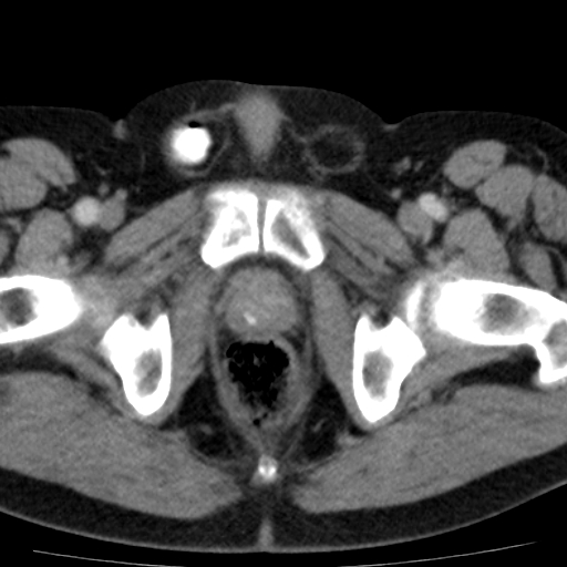 File:Bilateral direct inguinal herniae (Radiopaedia 17016-16719 B 24).jpg