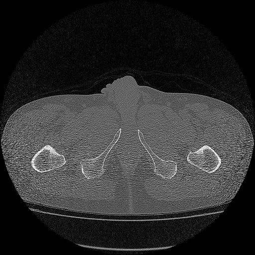 Bilateral femoral neck stress fractures (Radiopaedia 28666-28954 Axial bone window 86).png
