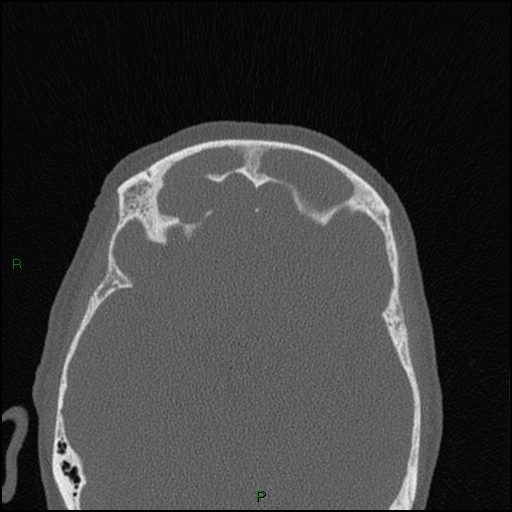 Bilateral frontal mucoceles (Radiopaedia 82352-96454 Axial bone window 100).jpg