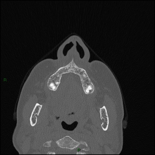 Bilateral frontal mucoceles (Radiopaedia 82352-96454 Axial bone window 244).jpg
