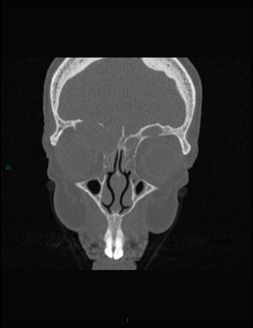 Bilateral frontal mucoceles (Radiopaedia 82352-96454 Coronal 95).jpg